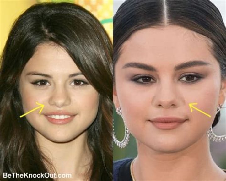Did Selena Gomez Get Plastic Surgery? Inside Rumors Life & Style